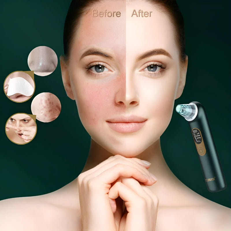 Turata USB Rechargeable Advanced Blackhead Remover
